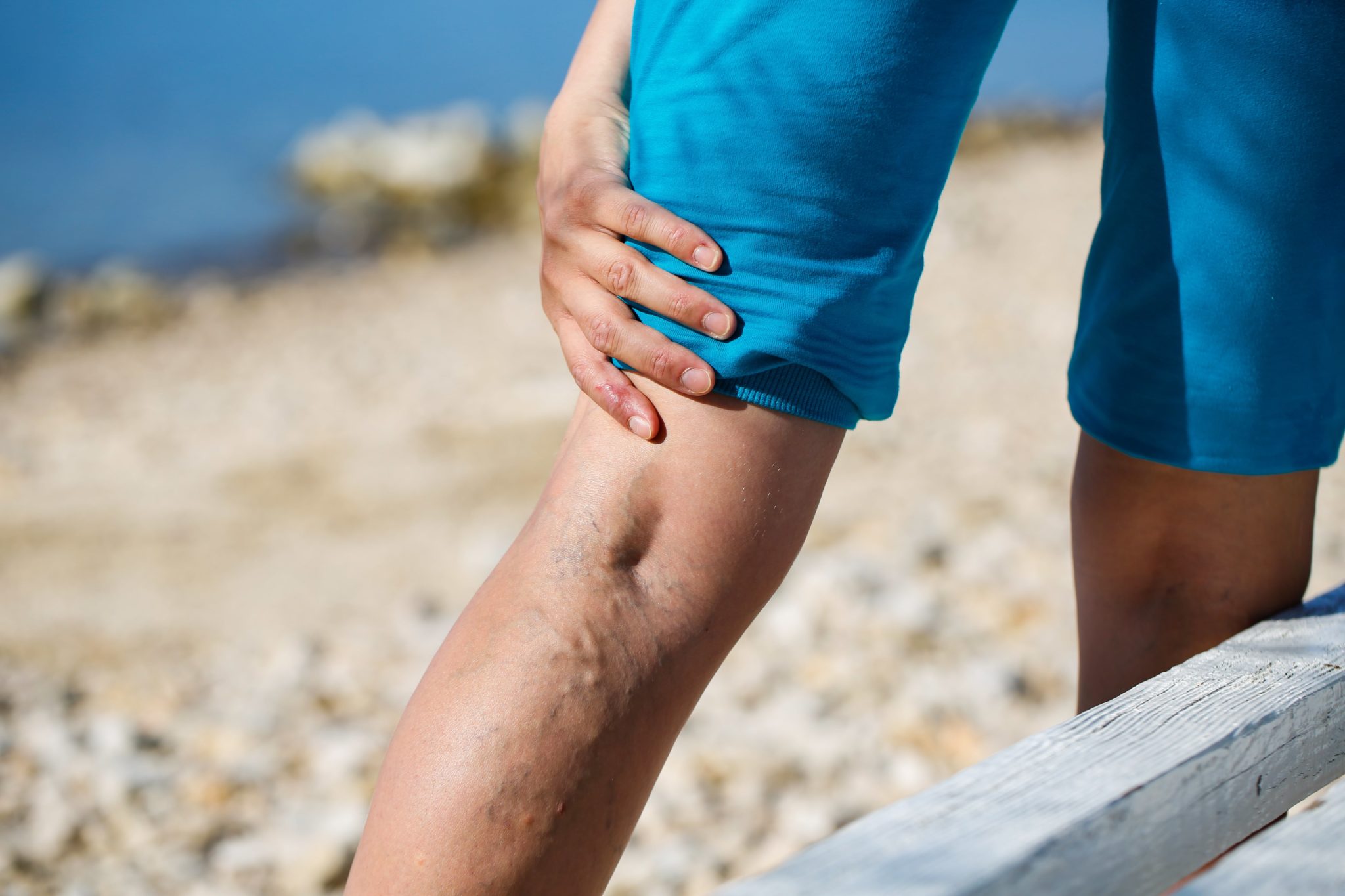 A woman with varicose veins holds her leg in pain