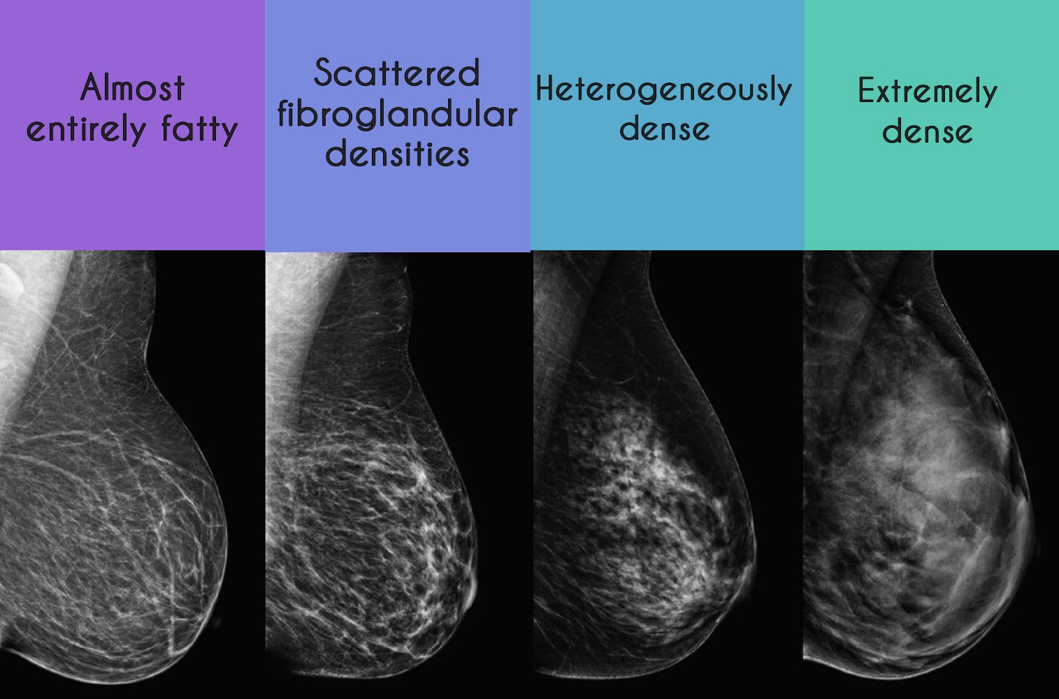 Dense Breast Tissue What To Know UVA Radiology