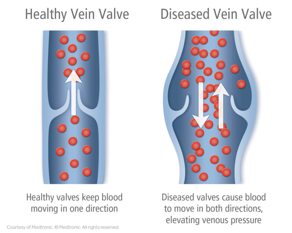 comparing healthy and diseased veins.