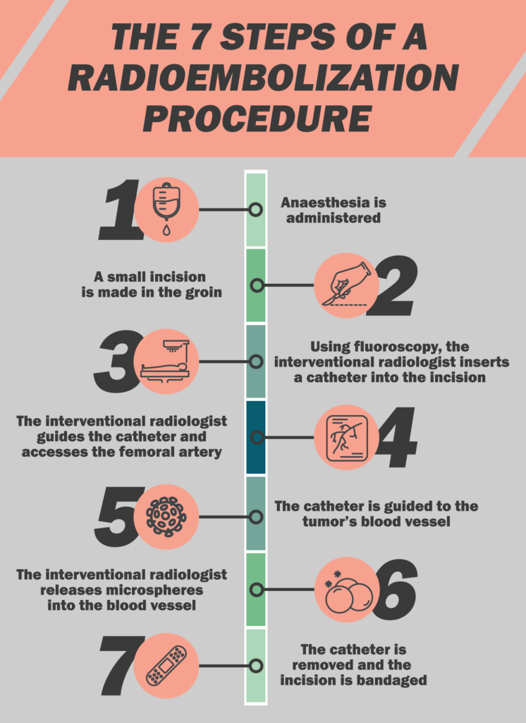 An infographic that explains the 7 steps of a radioembolization procedure