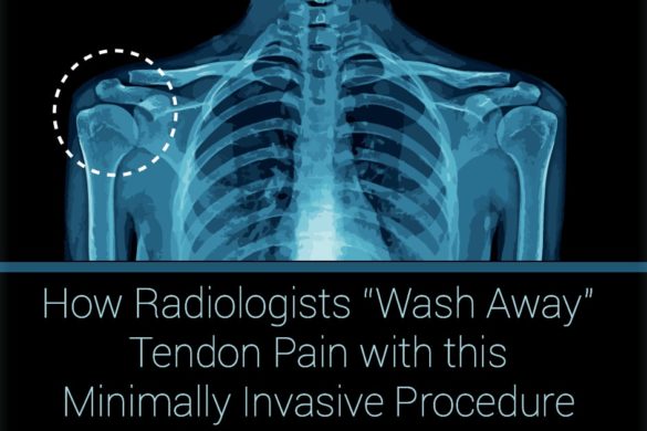 Calcific Tendonitis Archives UVA Radiology And Medical Imaging Blog