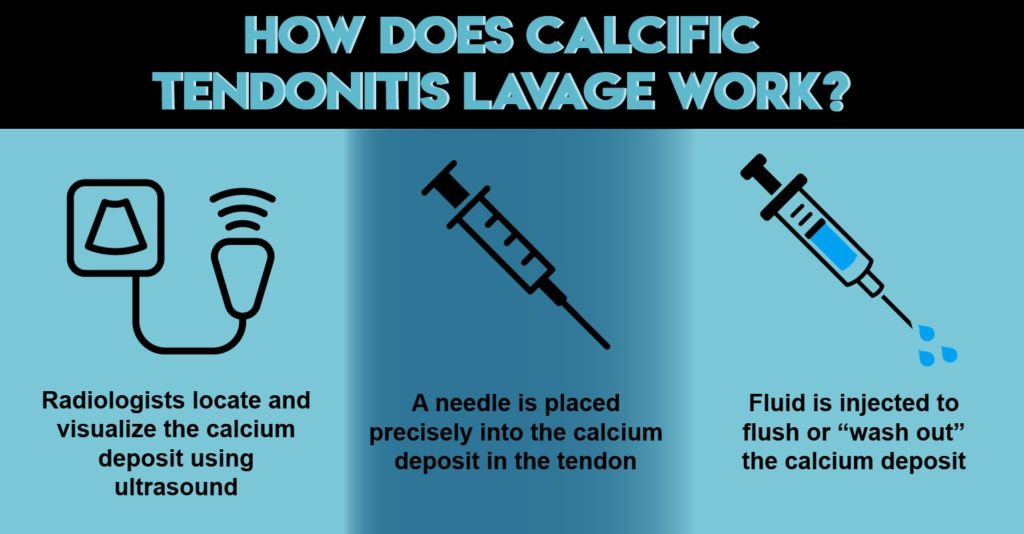 Infographic showing How Calcific Tendontis Lavage Works