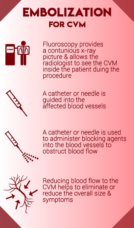 An infographic explaining the steps of a CVM embolization