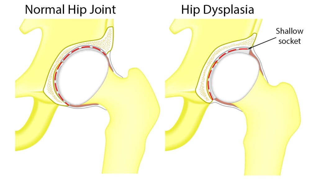 Diagram of a normal hip joint beside a hip joint with hip dysplasia.