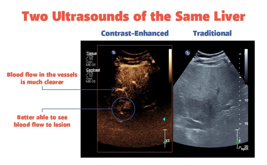 Two Ultrasounds of the Same Liver
