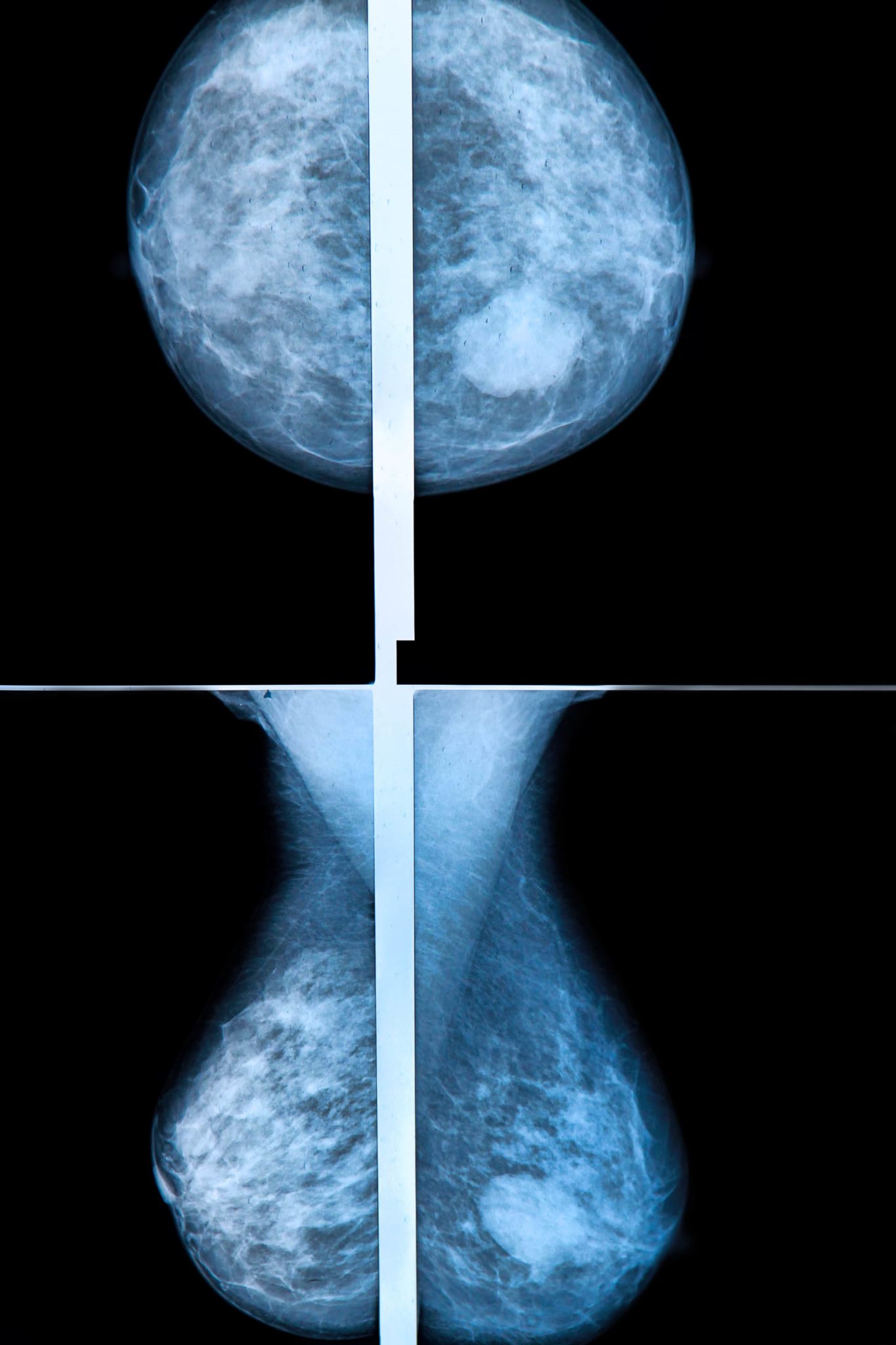 Image Comparing how a radiologist sees a 2D mammogram vs how a radiologists sees a 3D Mammogram