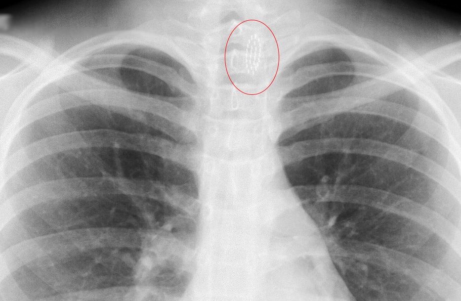 An x-ray after a patient swallows a foreign object