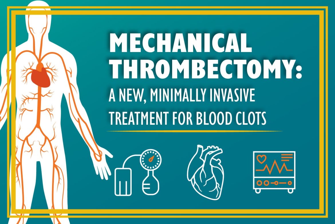 Mechanical Thrombectomy: A New, Minimally Invasive Treatment for Blood Clots