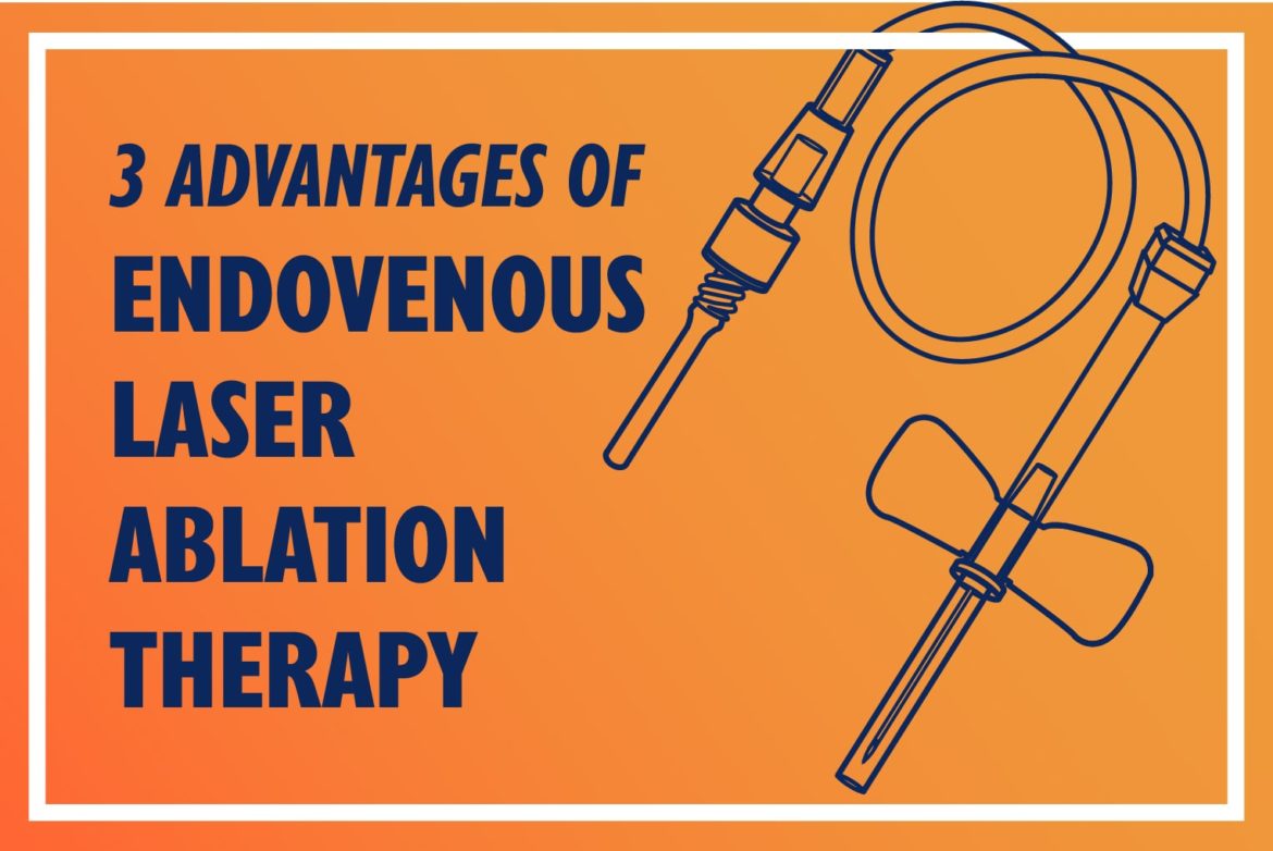 3 Advantages of Endovenous Laser Ablation Therapy