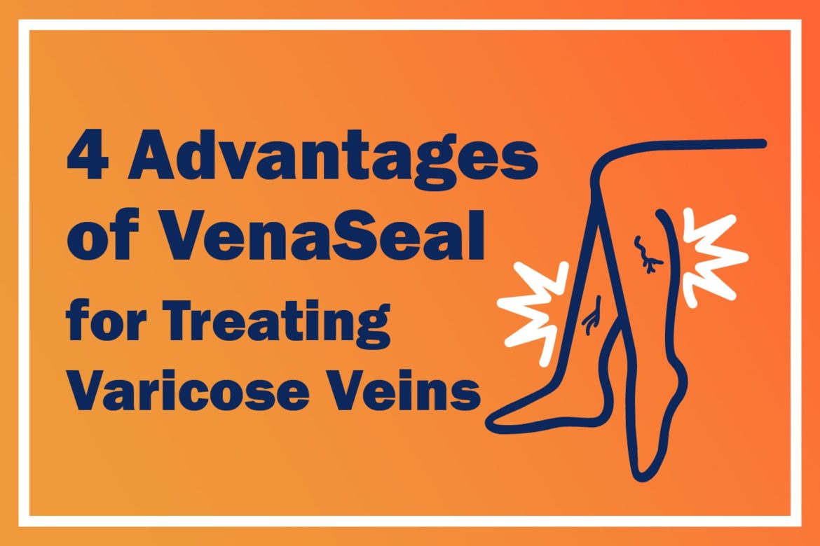 4 Advantages of VenaSeal for Treating Varicose Veins