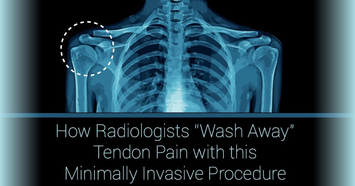 Header Image reading "How Radiologist "Wash Away" Tendon Pain with this Minimally Invasive Procedure