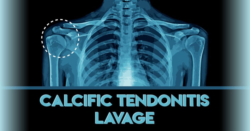 University Of Virginia Radiology Calcific Tendonitis Lavage