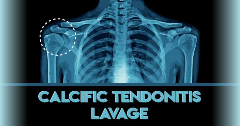 University of Virginia Radiology | Calcific Tendonitis Lavage