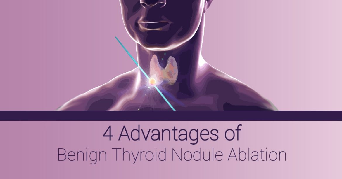 Header image for article reading "4 Advantages of Thyroid Nodule Ablation"