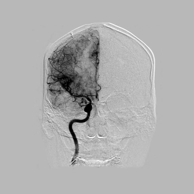 Angiogram: How Doctors Look Inside Blood Vessels Using X-rays