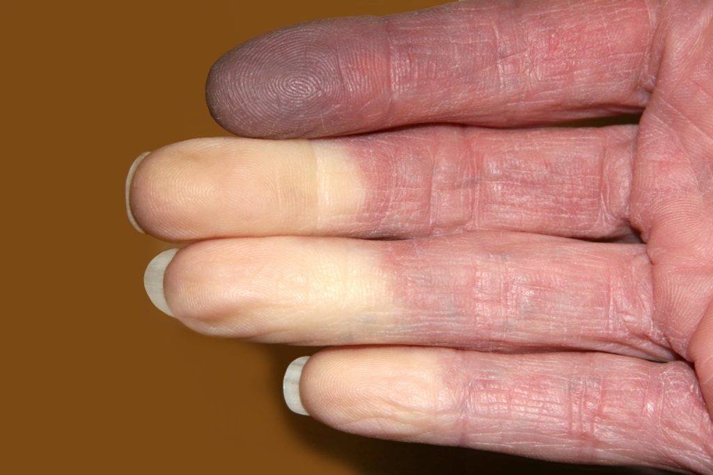 A photo of fingers turning white from a Raynaud's Attack