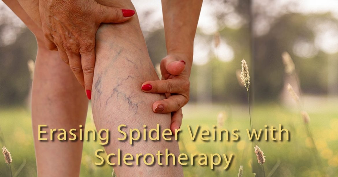UVA Radiology Inside View blog header image showing a women's leg with spider veins