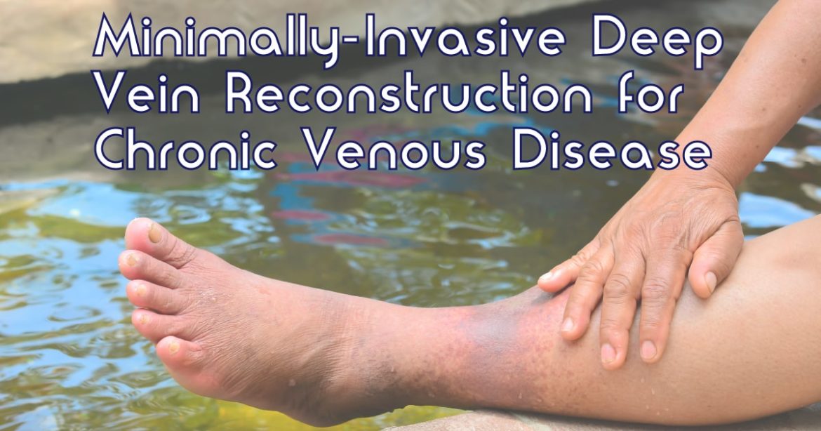 Header Image for Deep Vein Reconstruction Article Showing a leg with Chronic Venous Disease