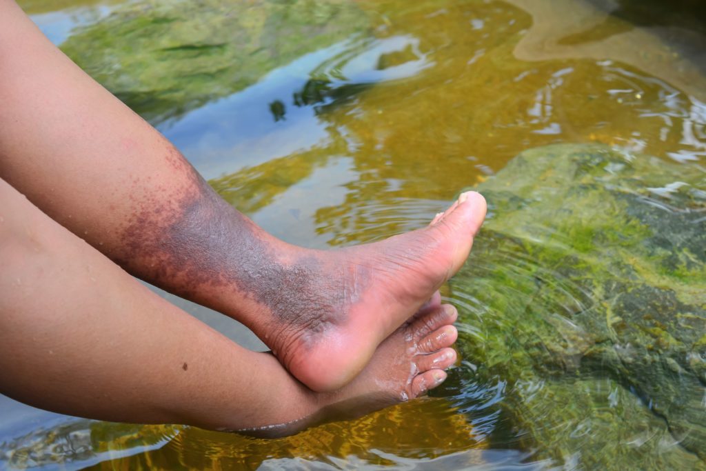 Leg & Foot with Chronic Venous Disease